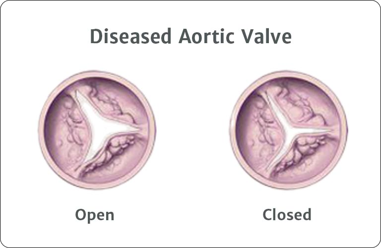 Diseased Aortic Valve