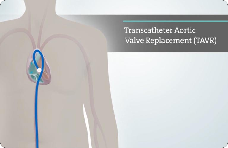 Transcatheter Aortic Valve Implantation (TAVI)