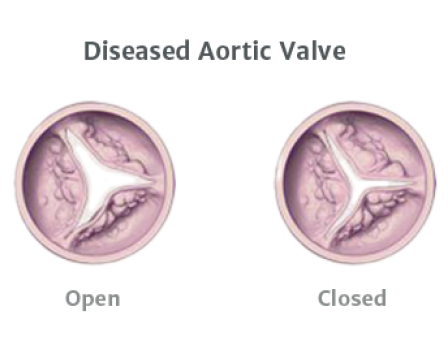 Diseased Aortic Valve