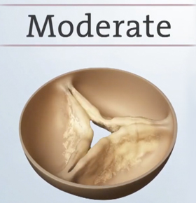 Moderate aortic stenosis