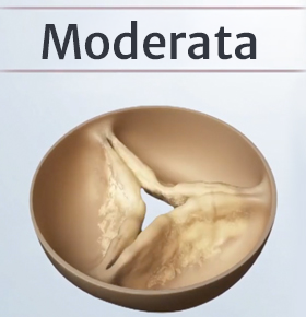 Moderate aortic stenosis