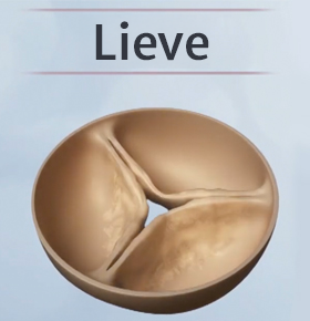 Mild aortic stenosis