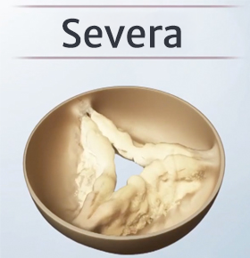 Severe aortic stenosis