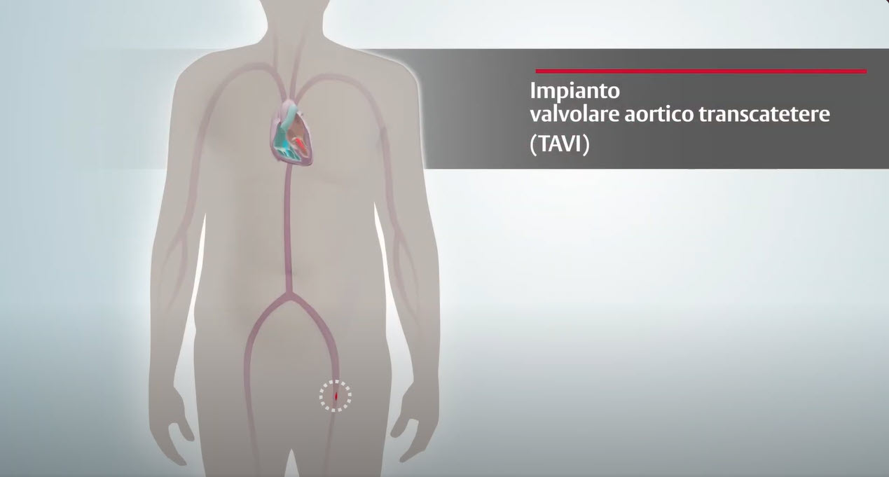 Transcatheter Aortic Valve Implantation (TAVI)