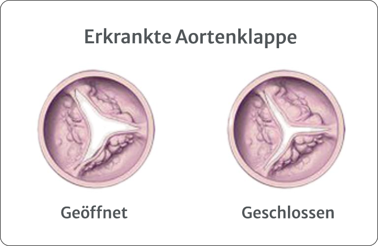 Failing Aortic Valve
