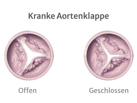 Diseased Aortic Valve