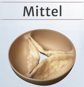Moderate aortic stenosis