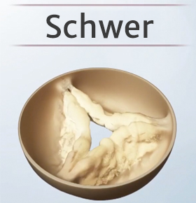 Severe aortic stenosis