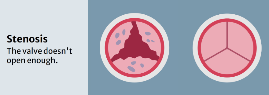 stenosis