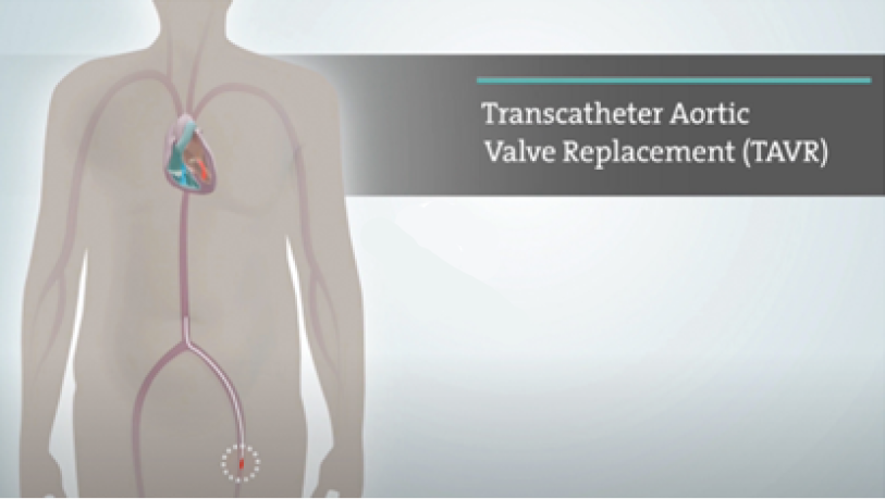 Transcatheter Video