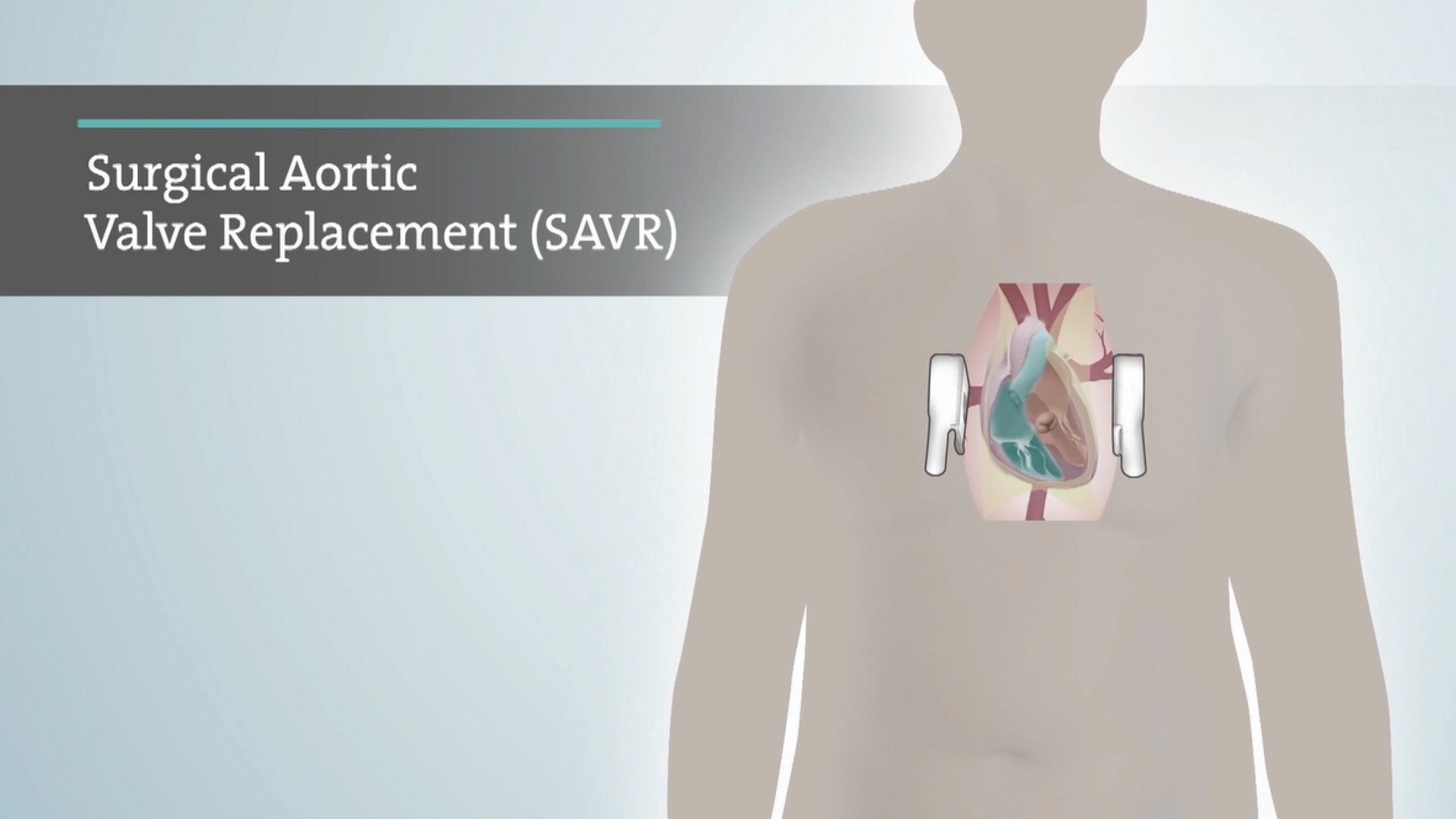 Surgical Aortic Valve Replacement (SAVR)