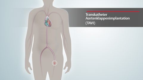 video zum TAVI-verfahren