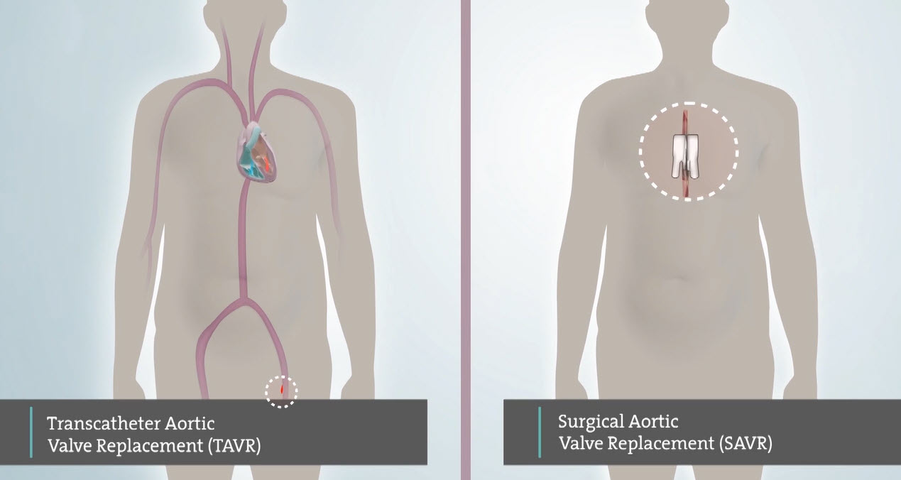 Transcatheter Aortic Valve Replacement (TAVR) versus SAVR