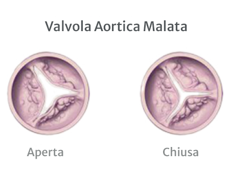 Diseased Aortic Valve
