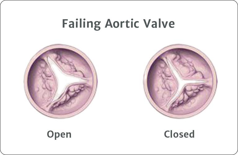 Failing Aortic Valve